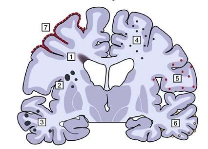 Klasik Laküner Sendromlar Saf motor hemiparezi: Lokalizasyon internal kapsül ve bazis pontis.
