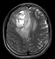 periferinde Tm