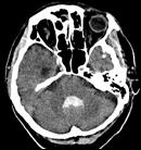 olgular) β amyloid proteinlerinin birikimi: