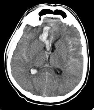 Intraserebral kanama