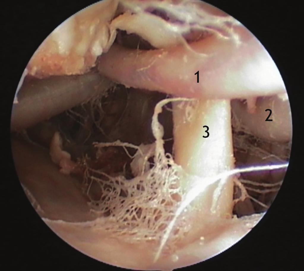 Bir kadavrada labirentin arterin baziller arterden çıktığı izlenirken, diğerlerinde anterior inferior serebellar arterden çıktığı görüldü.