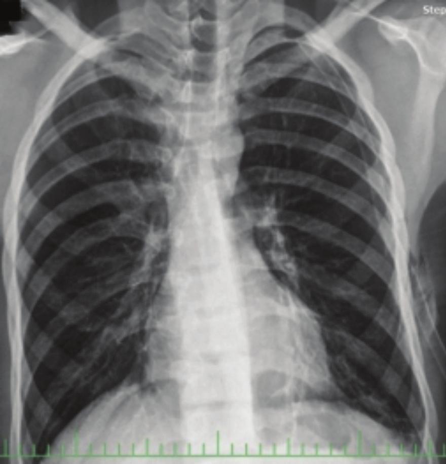 12 Pnömotoraks / Pneumothorax rasyona devam edilmelidir.