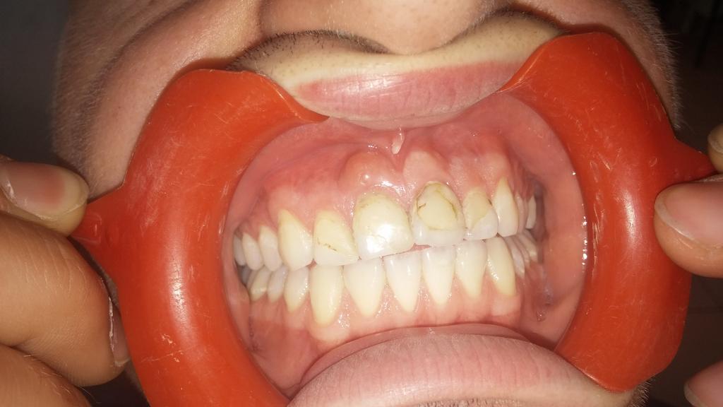 110 BERKAN ÇELİKTEN-PINAR KAYNAR-FATMA GÜL ZIRAMAN-HATİCE YALNIZ la kök ve kanala sahip maksiller santral keser dişlerin 24 olgu raporunun 13 ü dental anomaliler eşliğinde rapor edilmiştir.