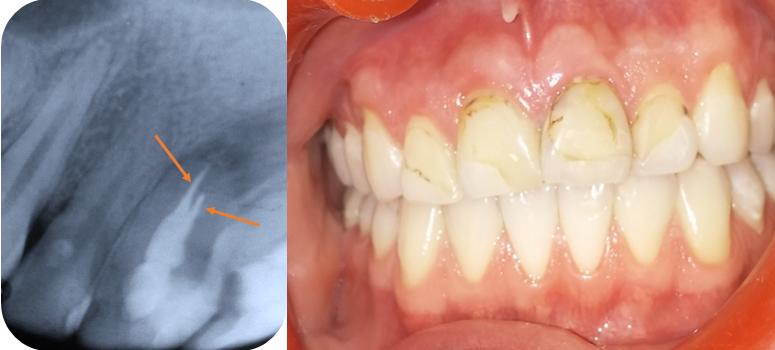 Sol maksiller santral dişin kök kanal dolgusu TARTIŞMA Maksiller santral keser dişlerin, genel olarak tek kök ve tek kök kanalı içerdiği, nadir olarak da lateral kanallar ve apikal sonlanmalar