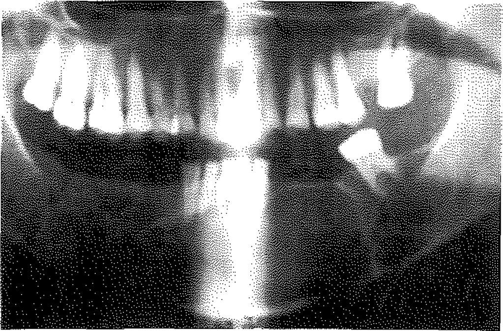 Şekil 1: Ameloblastomalı hastanın preoperatif panoramik görüntüsü. Şekil 5: Radiküier kistin preoperatif görünümü.