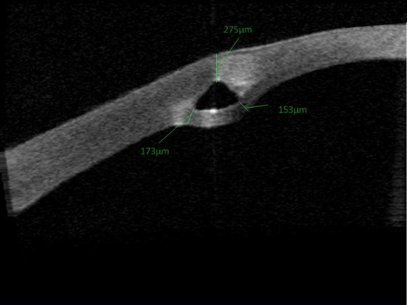 Resim 1 İntrastromal ring