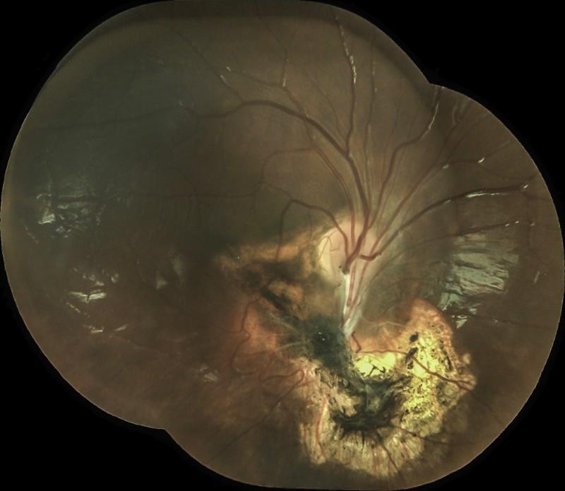 Resim 2 Yirmi dört aylıkken persistan fetal vakülatüre bağlı traksiyonel retina dekolmanı nedeniyle pars plikata/plana lensektomi ve vitrektomi uygulanan 5 yaşındaki erkek hastanın postoperatif