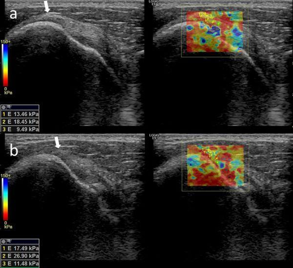 Resim Açıklaması: a) 19 yaşında erkek normal supraspinatus tendon gri skala ultrason ve shear elastografik görüntüleri, b) 54