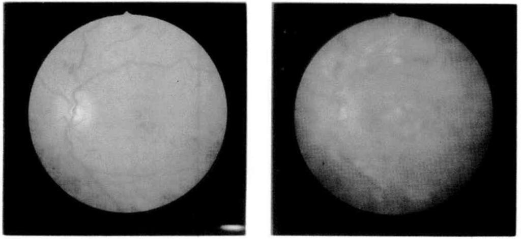 OFTALMOLOJİ MART 1993 CİLT 2 SAYI 1 Şekil 1. Santral retinal ven kök trombozu (Inkomplet tip) erken dönem fundüs fotoğrafı Şekil 2.