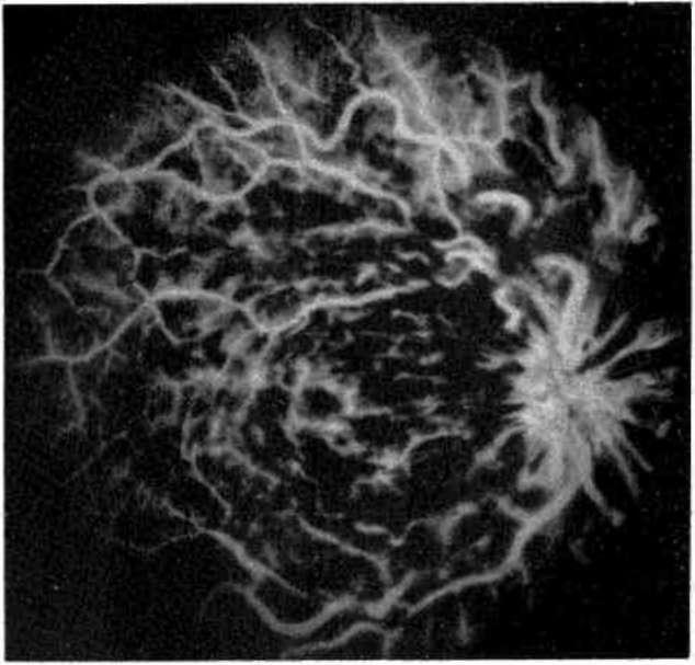 Santral retinal ven kök trombozu iskemik tıp 3. ay FFA fotoğrafı Şekil 4.