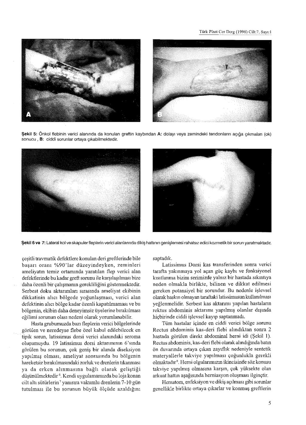 Türk Plast Cer Derg (1998) Cilt:7, Sayı: 1 Şekil 5; Önkol flebinin verici alarmda da konulan greftin kaybından A: dolayı veya zemindeki tendonların açığa çıkmaları (ok) sonucu, B: ciddi sorunlar