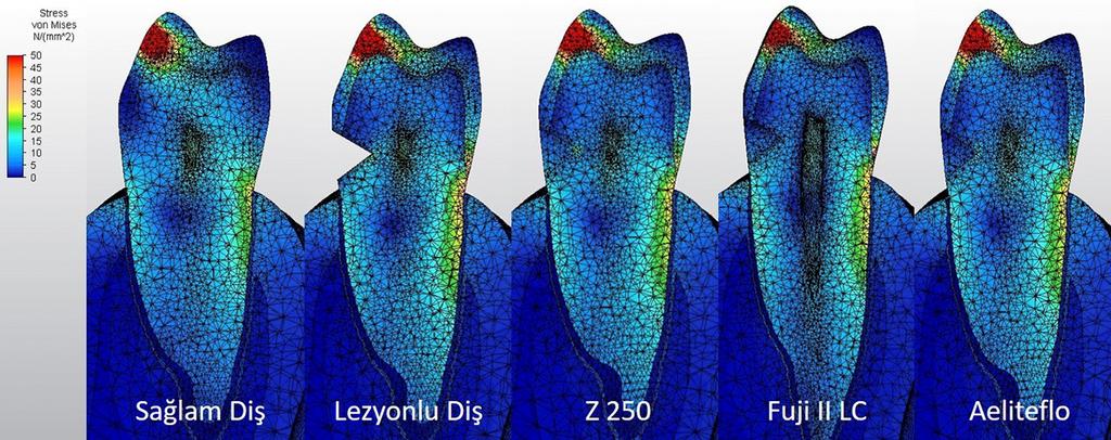 servikal bölgede yoğun stres oluştuğu görülmektedir (Resim 6). Sağlam dişin kron bölgesinde kök bölgesinden daha yoğun stresler görülmektedir.