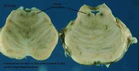 karıncığın tabanının üst parçasında periventricular gri maddenin yanında bulunur.