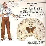 KORE (chorea) Huntington s disease Huntington hastalığı Otozomal dominant geçiş gösteren kalıtsal bir hastalıktır.