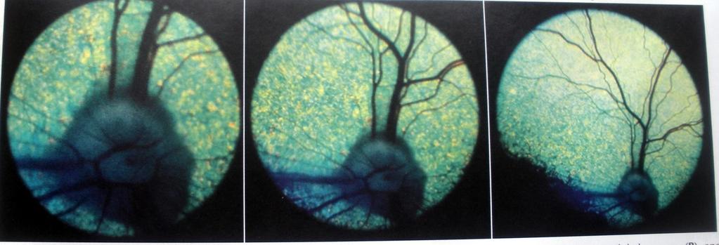 Direkt Oftalmoskopi Panoptik Monokuler oftalmoskop
