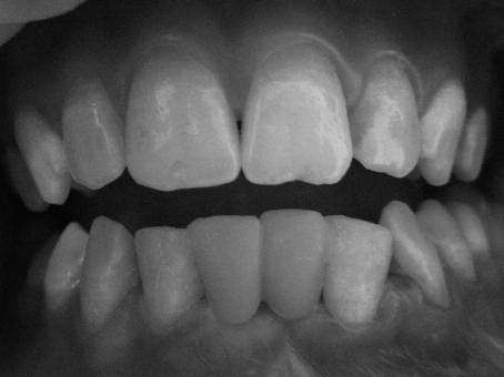 RESİM 5: Köprünün ağız içerisindeki görüntüsü. için dişsiz boşluğun lokalizasyonu, boşluğun uzunluğu ve hastanın kapanışının değerlendirilmesi gerekmektedir.