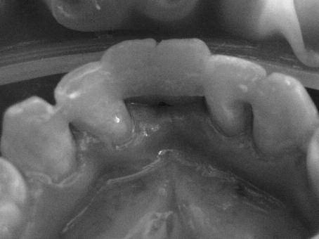 Santral dişleri içeren bir köprünün yerleştirilebilmesi için yeterli yerin bulunmaması nedeni ile ortodontik tedavi planlandı.