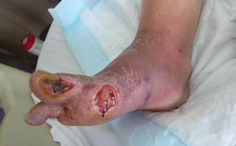 ve çatlakları olan deri yapısı Gecikmiş iyileşme Yüksek enfeksiyon riski TİPİK YERLEŞİM Ayağın basınç noktalarında