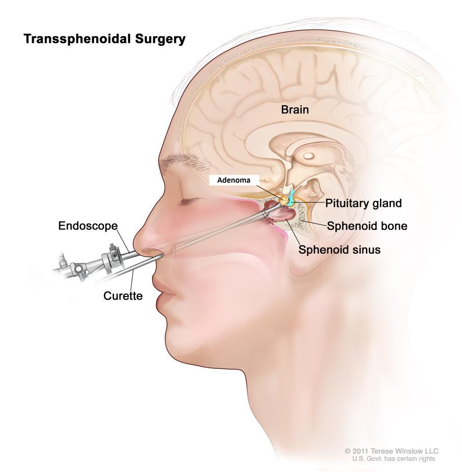Tedavi-2 Hipofiz adenomu Trans-sfenoidal cerrahi Başarı şansı % 90 İkinci Trans-sfenoidal cerrahi Başarı şansı