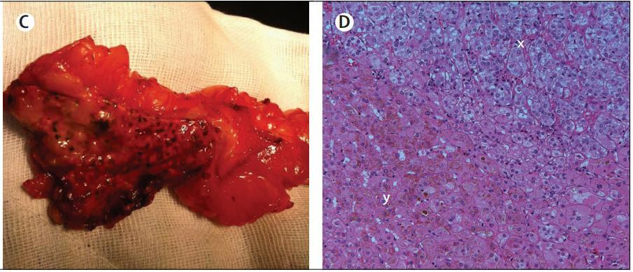 Cushing's conundrum: an unusual case of primary pigmented nodular