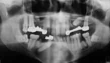 Panoramik radyografta sağ alt birinci büyük azı dişten başlayan, sağ gömülü kanin dişi çevreleyen ve sol alt kanin diş bölgesine kadar uzanan, iyi sınırlı, yaklaşık 7 cm çapında uniloküler