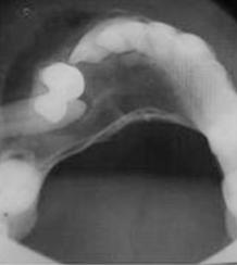 Oklüzal radyografta ise sağ alt birinci büyük azı dişten başlayan sol alt kanin diş bölgesine kadar uzanan radyolusent alan içinde yer yer radyoopak alanların eşlik ettiği radyolusensi izlendi (Resim