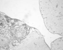 RESİM 5: İntrakistik proliferasyonla karakterize tümöral gelişim (HE, x4). RESİM 6: Rozet benzeri yapılar oluşturan tümör hücreleri ve eozinofilik birikimler (HE, x20).