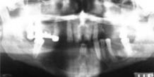 12 Bu makalede 35 yaşındaki erkek hastada sol alt lateral kesici dişten başlayıp sağ alt birinci büyük azı dişi bölgesine kadar uzanan ve sağ alt gömülü kanin dişi de içine alan foliküler tipte bir