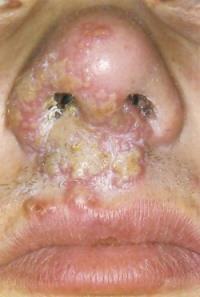 Herpes Simplex HSV Tip 1-2 Oral ya da