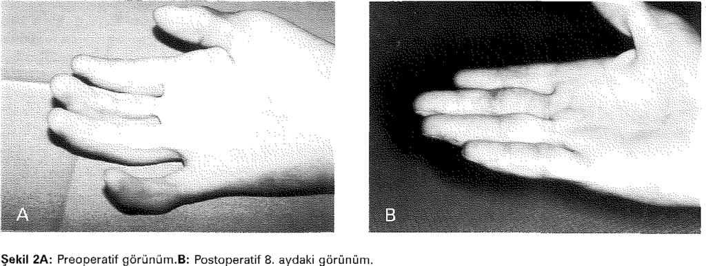 Tedavi edilen parm aklarda fleksiyon kontraktürleri yinelemedi (Resim 2 ve 3).
