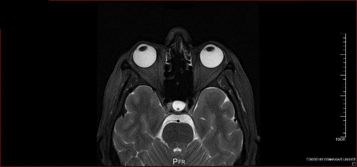 Bu kısımda rasgele seçilen bir hastanın MR görüntüsü üzerinde örnek bir MATLAB görüntü işleme süreci anlatılmıştır. Diğer hastaların MR görüntüleri de aynı süreçten geçirilmiştir.