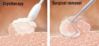 Tedavi Genital siğiller kendiliğinden gerileyebilir Refrakter ve reküren lezyonlarda tedavi