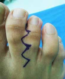 Çocukluk çağı ayak parmak deformiteleri 443 Şekil 17. a, b. On yedi yaşında kız hastada izlenen basit yapışık parmaklılık ve ameliyat sonrası görünümü. Şekil 18. a, b. Üç yaşında kız bir hastanın basit yapışık parmaklılık ve ameliyat sonrası görüntüsü.