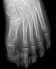 [12] Dev Parmaklılık (Makrodaktili) Parmak yapılarındaki aşırı büyüme nedeniyle ortaya çıkan deformitedir. Sıklıkla ikinci ve üçüncü parmakları etkiler. Bazen metatars tutulumu ile birliktedir.