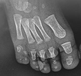 Kararlı tipte doğumda var olan dev parmaklılık diğer parmaklarla orantılı olarak büyürken, ilerleyici tipte deformite erken çocukluk çağında belirginleşmeye başlar ve diğer parmaklara göre daha hızlı