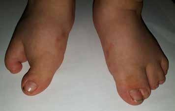 Çocukluk çağı ayak parmak deformiteleri 445 Şekil 21. a, b. Sağda yarık ayak deformitesine ait klinik ve radyolojik görüntüler.