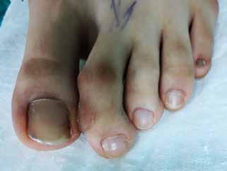 Çocukluk çağı ayak parmak deformiteleri 435 Şekil 1. Ayak parmak deformitelerinin en sık neden olduğu yakınma parmakta gelişen nasırlar nedeniyle ağrı ve ayakkabı giymede zorlanmadır.