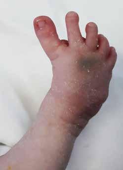 Çocukluk çağı ayak parmak deformiteleri 437 Şekil 5. Doğumsal halluks varus olgusu. Şekil 6. a, b. Kısa dördüncü metatarsa ait klinik ve radyolojik bir örnek olgu.