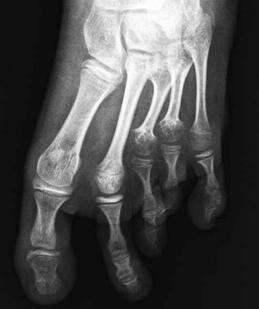[13] Osteotominin az-girişimsel yöntemlerle yapılması, asgari damar hasarına yol açar ve bu şekilde osteogenezin başarısı arttırılmış olur.