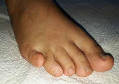 Deformitenin fleksör tendon gerginliğine bağlı olduğu düşünülen durumlarda, ayak bileği fleksiyona alındığında tendon gerginliği