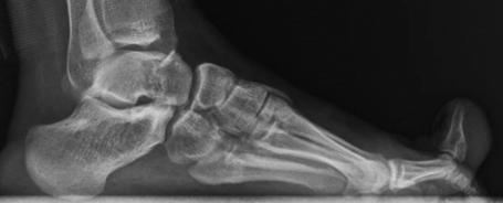 Kalkık parmak (Cock-up Toe) Deformitesi Kalkık parmak deformitesi parmağın MTF eklemden aşırı dorsifleksiyonu olarak tanımlanır.
