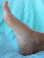 Çocukluk çağı ayak parmak deformiteleri 441 Şekil 12. Pes cavus deformitesine eşlik eden özellikle ikinci parmakta pençe parmak deformitesi izlenmektedir. Şekil 13. a, b. Checkrein deformitesi.