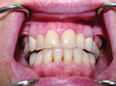 OLGU 2 Elli yaşındaki erkek hasta, yaklaşık 1,5 aydır oral mukozada mevcut olan ağrılı ülserler nedeni ile İstanbul Üniversitesi Diş Hekimliği Fakültesi Ağız, Diş ve Çene Hastalıkları Bilim Dalı
