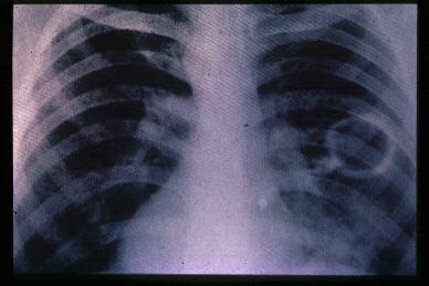 Tuberküloz Parankim hasarı