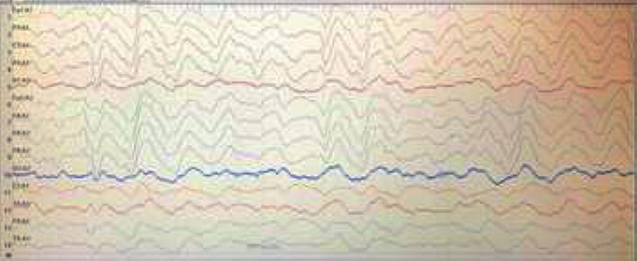 RESİM 2: Nonkonvülzif status epileptikus EEG'si. RESİM 3: Nonkonvülzif status epileptikus EEG'si.