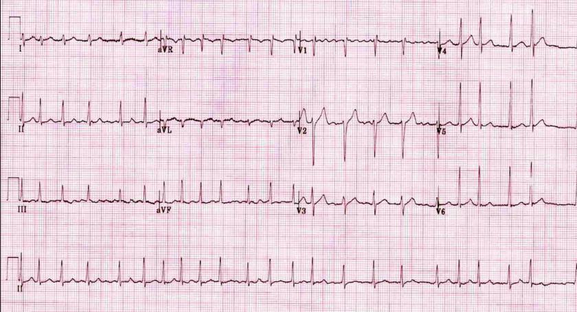 Atrial fibrilasyon EKG Ventriküler ve atriyal ritim düzensiz Atriyal hız 400-700 /dk arasındadır Organize P