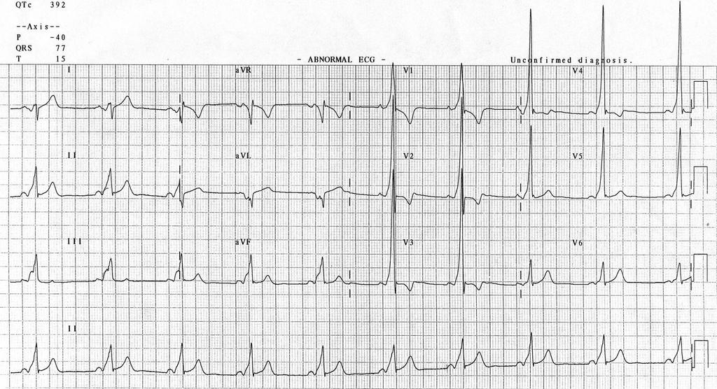 Tip A WPW left-sided accessory pathway V1-3 büyük R ve T (-) RVH yi