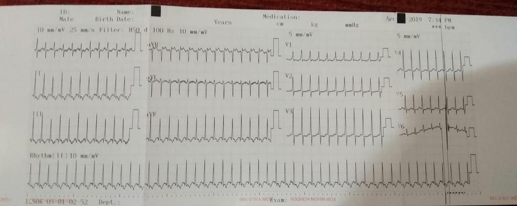 EKG