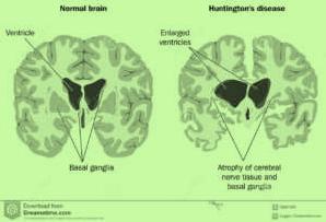 Huntington hastalığı nörolojik hastalıkların sıklıkla Psikiyatrik rahatsızlıkla kendisini göstermesine örnek teşkil etmektedir.