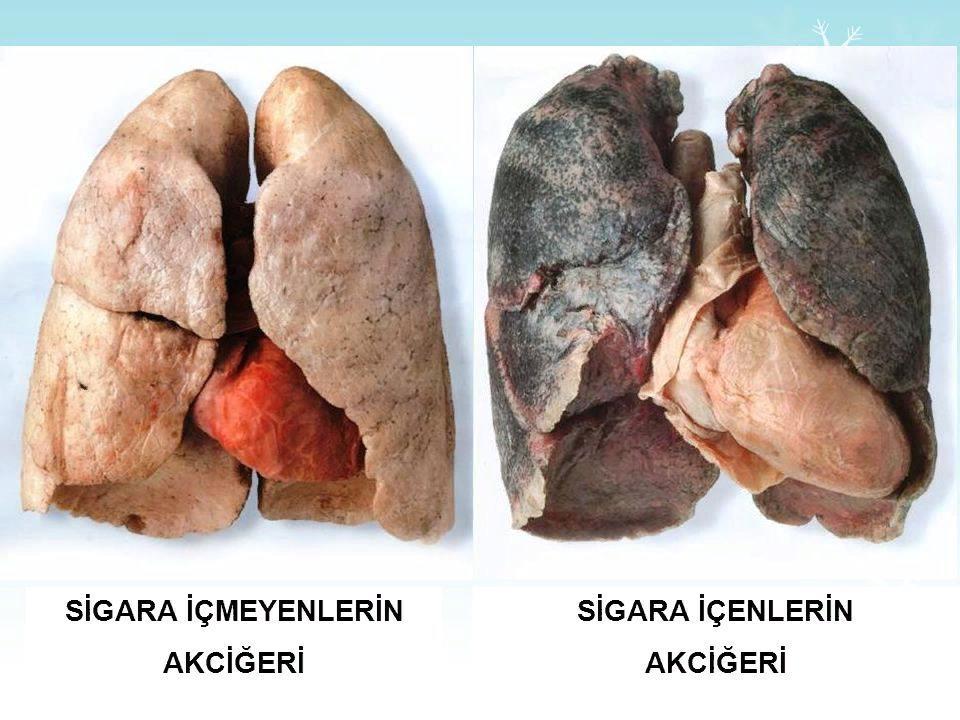 KOAH kronik obstrüktif akciğer hastalığı- ; çok büyük bir kısmı sigara kökenlidir.